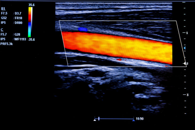 Vascular Ultrasound Imaging - EchoWaves,LLC